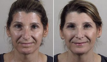 Microneedling 4