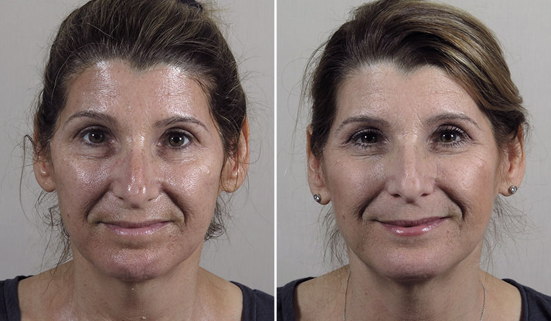 Microneedling 4