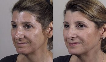 Microneedling 4