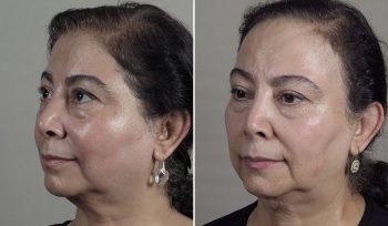 Microneedling 5