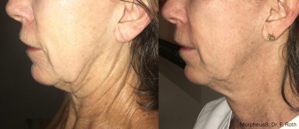 before after morpheus8 by inmode neck tightening