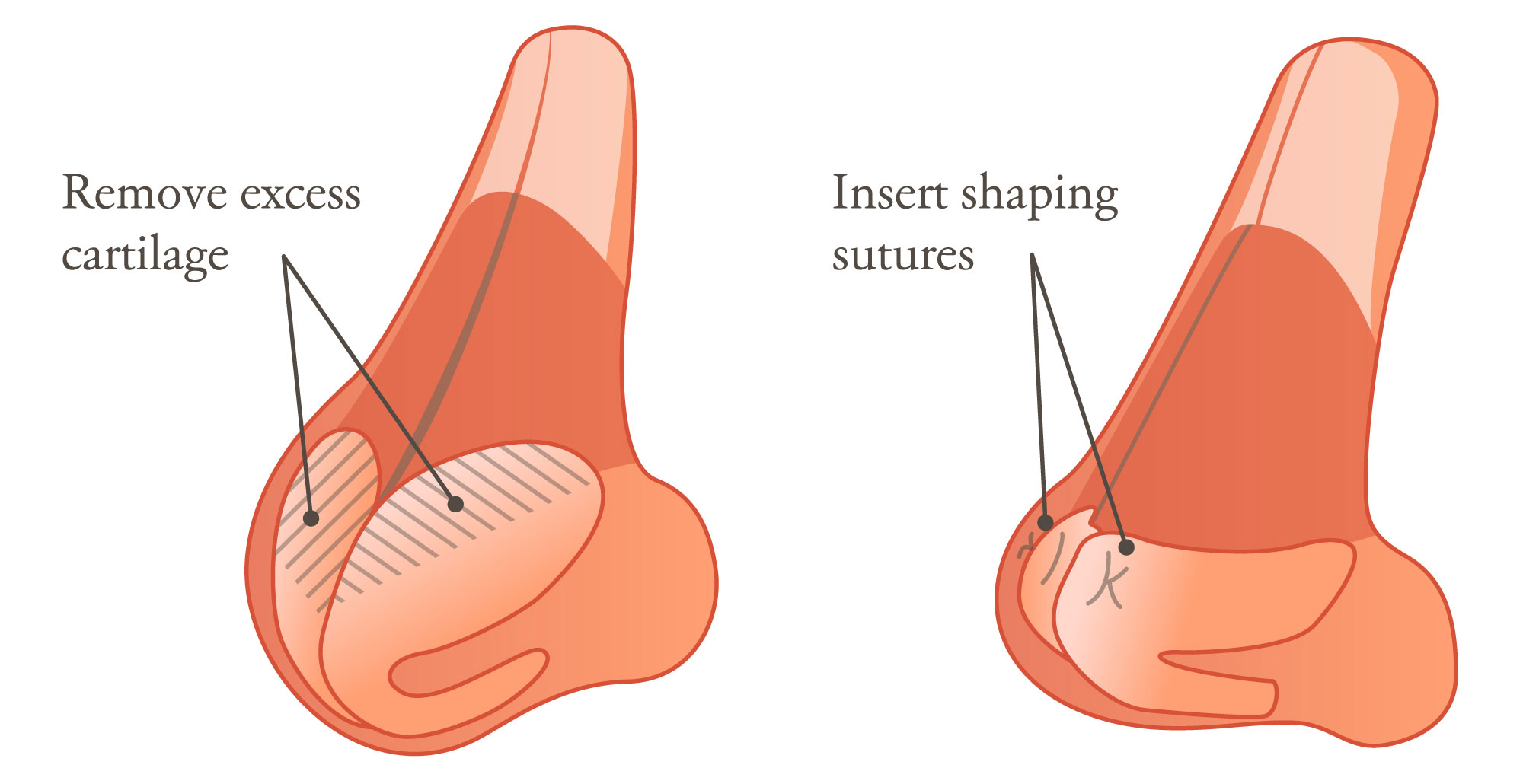 Rhinoplasty procedure at Parker Center New Jersey