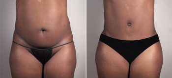 Mommy Makeover Patient 37