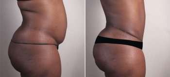 Mommy Makeover Patient 37