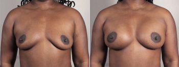 Mommy Makeover Patient 37