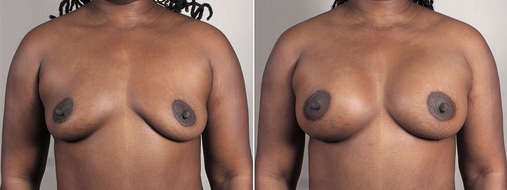 Mommy Makeover Patient 37