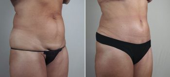 Mommy Makeover Patient 33