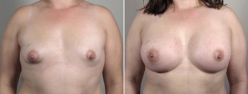 Breast Enlargement (Augmentation) Patient 103