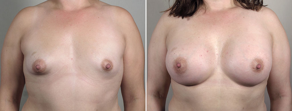 Breast Enlargement (Augmentation) Patient 103