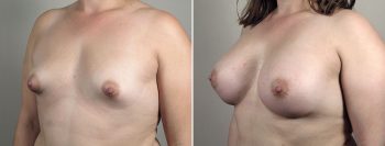 Breast Enlargement (Augmentation) Patient 103