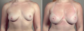 Breast Enlargement (Augmentation) Patient 105