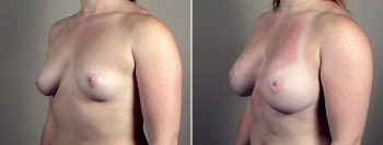 Breast Enlargement (Augmentation) Patient 105