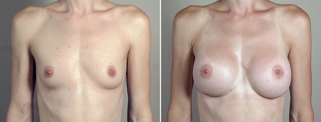 Breast Enlargement (Augmentation) Patient 106