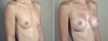 Breast Enlargement (Augmentation) Patient 106
