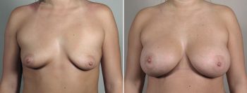 Breast Enlargement (Augmentation) Patient 107