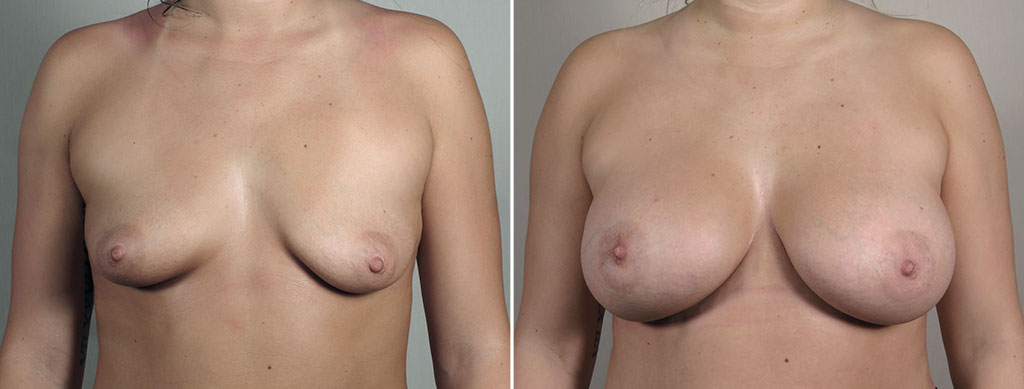 Breast Enlargement (Augmentation) Patient 107