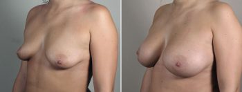Breast Enlargement (Augmentation) Patient 107