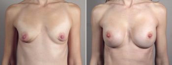 Breast Enlargement (Augmentation) Patient 109
