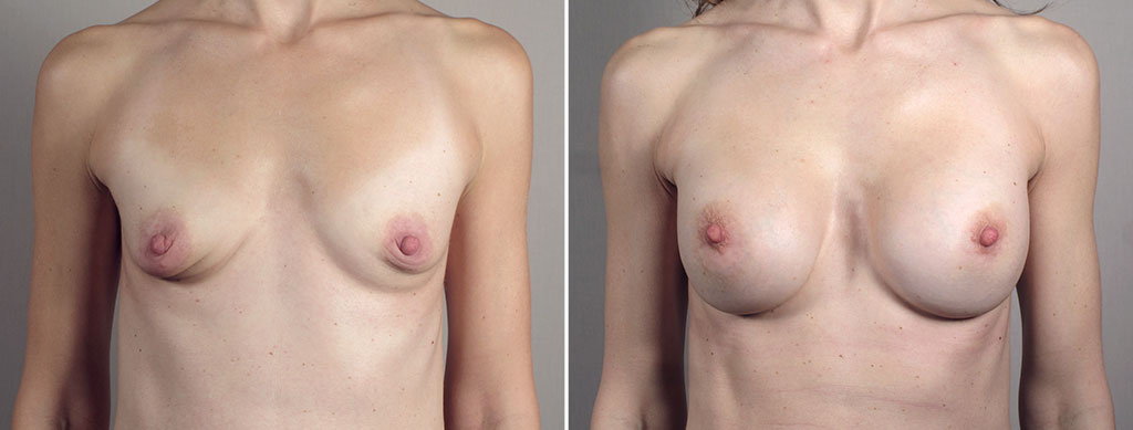 Breast Enlargement (Augmentation) Patient 109