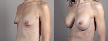 Breast Enlargement (Augmentation) Patient 109