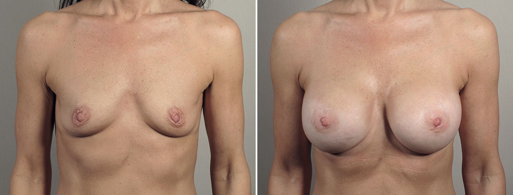 Breast Enlargement (Augmentation) Patient 110