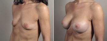 Breast Enlargement (Augmentation) Patient 110