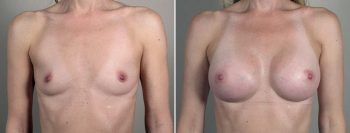 Breast Enlargement (Augmentation) Patient 111