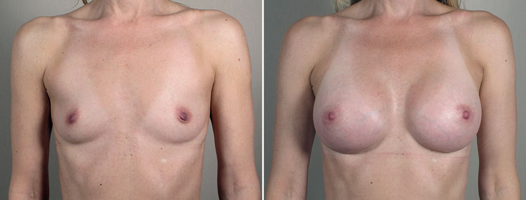 Breast Enlargement (Augmentation) Patient 111
