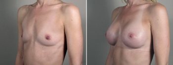 Breast Enlargement (Augmentation) Patient 111