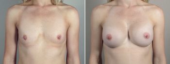 Breast Enlargement (Augmentation) Patient 112