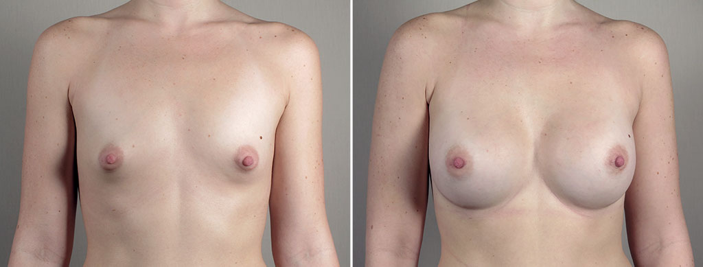 Breast Enlargement (Augmentation) Patient 113