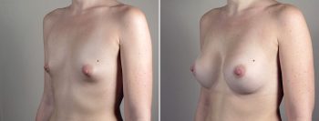 Breast Enlargement (Augmentation) Patient 113