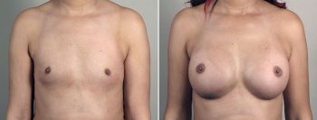 Breast Enlargement (Augmentation) Patient 114