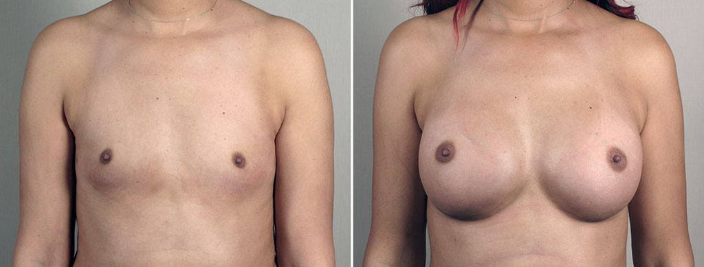 Breast Enlargement (Augmentation) Patient 114