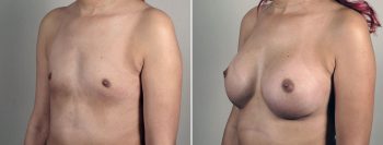 Breast Enlargement (Augmentation) Patient 114