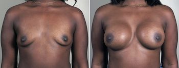 Breast Enlargement (Augmentation) Patient 115