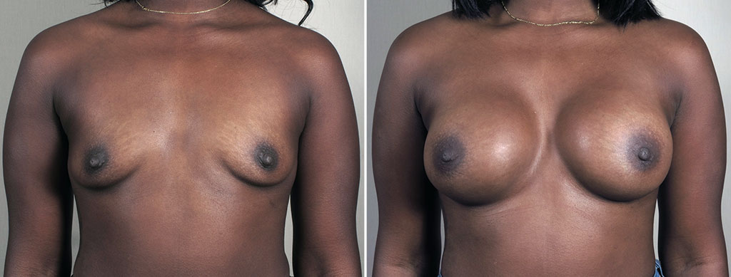 Breast Enlargement (Augmentation) Patient 115