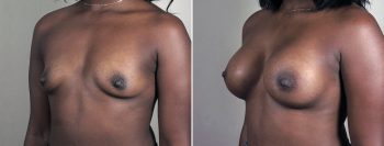 Breast Enlargement (Augmentation) Patient 115