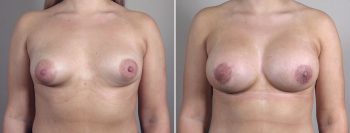 Breast Enlargement (Augmentation) Patient 118