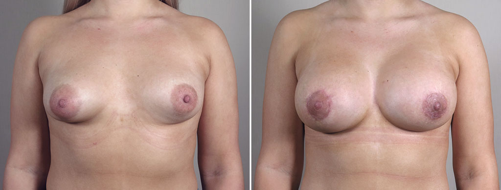 Breast Enlargement (Augmentation) Patient 118