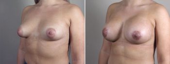 Breast Enlargement (Augmentation) Patient 118
