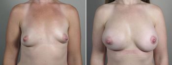 Breast Enlargement (Augmentation) Patient 119