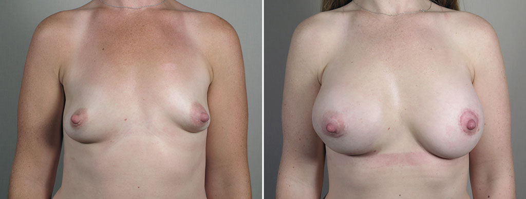 Breast Enlargement (Augmentation) Patient 119