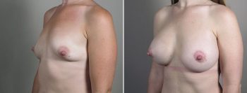 Breast Enlargement (Augmentation) Patient 119