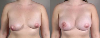 Breast Enlargement (Augmentation) Patient 104
