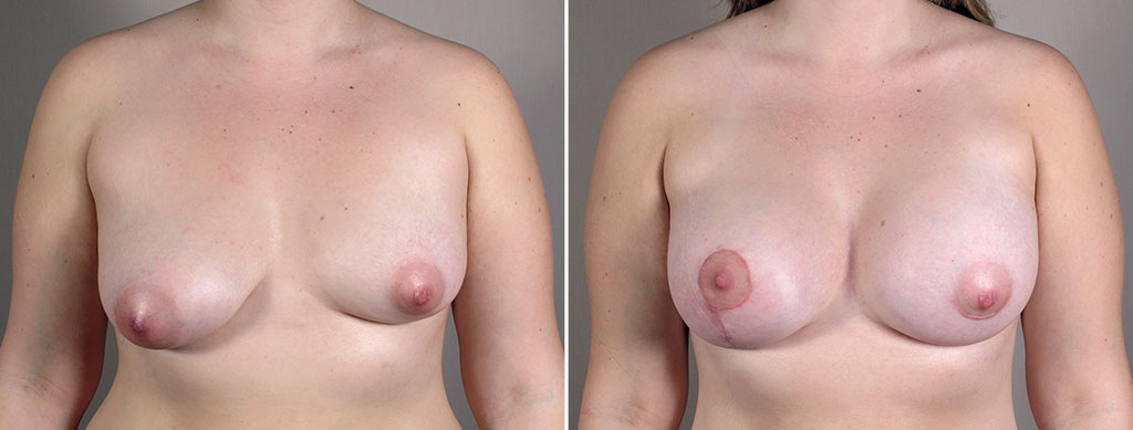 Breast Enlargement (Augmentation) Patient 104
