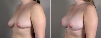 Breast Enlargement (Augmentation) Patient 104