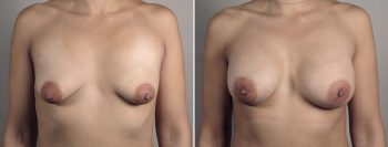 Breast Enlargement (Augmentation) Patient 102