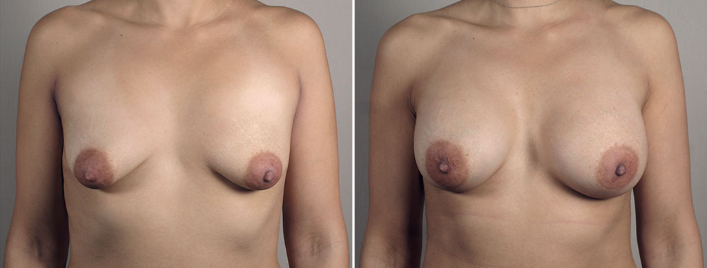 Breast Enlargement (Augmentation) Patient 102