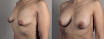 Breast Enlargement (Augmentation) Patient 102
